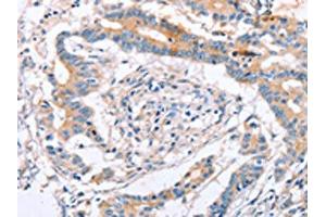 The image on the left is immunohistochemistry of paraffin-embedded Human colon cancer tissue using ABIN7129824(IGSF8 Antibody) at dilution 1/15, on the right is treated with fusion protein. (IGSF8 anticorps)