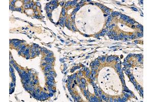 ABIN6261350 and ABIN6266893 at 1/100 staining Human colorectal cancer by IHC-P. (DOK3 anticorps  (Internal Region))