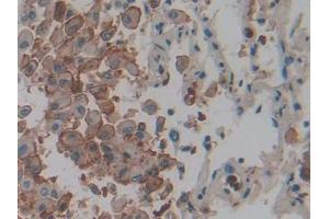 DAB staining on IHC-P; Samples: Human Lung cancer Tissue) (IL1A anticorps  (AA 113-271))