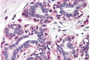 Human Breast (formalin-fixed, paraffin-embedded) stained with RAMP3 antibody ABIN290466 at 20 ug/ml followed by biotinylated goat anti-rabbit IgG secondary antibody ABIN481713, alkaline phosphatase-streptavidin and chromogen. (RAMP3 anticorps  (N-Term))