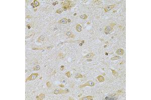 Immunohistochemistry of paraffin-embedded human brain cancer using CAMK1D Antibody (ABIN5975586) at dilution of 1/100 (40x lens). (CAMK1D anticorps)