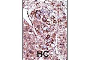 Formalin-fixed and paraffin-embedded human cancer tissue reacted with the primary antibody, which was peroxidase-conjugated to the secondary antibody, followed by AEC staining.