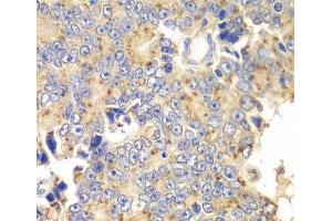 Immunohistochemistry of paraffin-embedded Human prostate cancer using PICK1 Polyclonal Antibody at dilution of 1:100 (40x lens). (PICK1 anticorps)
