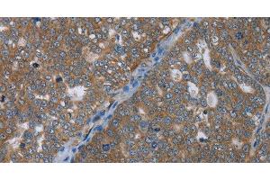 Immunohistochemistry of paraffin-embedded Human ovarian cancer using GABRB1 Polyclonal Antibody at dilution of 1:50 (GABRB1 anticorps)