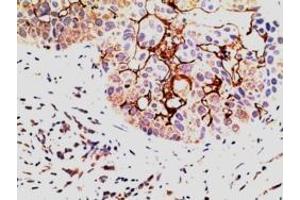 ABIN185076 (5µg/ml) staining of paraffin embedded Human Breast Carcinoma. (EPS8 anticorps  (C-Term))