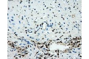 Immunohistochemical staining of paraffin-embedded prostate tissue using anti-HK2mouse monoclonal antibody. (Hexokinase 2 anticorps)
