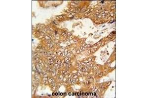 FBXO34 Antibody (C-term) (ABIN651879 and ABIN2840436) immunohistochemistry analysis in formalin fixed and paraffin embedded human colon carcinoma followed by peroxidase conjugation of the secondary antibody and DAB staining. (FBXO34 anticorps  (C-Term))