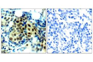 Immunohistochemical analysis of paraffin-embedded human breast carcinoma tissue using p44/42 MAP Kinase (phospho-Thr202) antibody (E011245). (ERK1/2 anticorps  (pThr202))