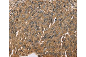 Immunohistochemistry of Human breast cancer using SCGB2A1 Polyclonal Antibody at dilution of 1:50 (SCGB2A1 anticorps)