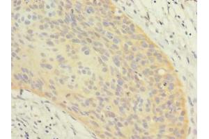 Immunohistochemistry of paraffin-embedded human cervical cancer using ABIN7162366 at dilution of 1:100 (OXR1 anticorps  (AA 401-600))