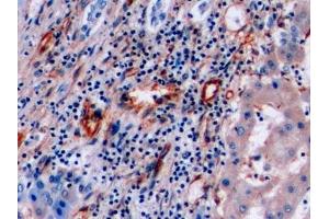 Detection of VIM in Human Liver cancer Tissue using Polyclonal Antibody to Vimentin (VIM)