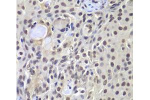 Immunohistochemistry of paraffin-embedded Human well-differentiated squamous skin carcinoma using PRKDC Polyclonal Antibody at dilution of 1:100 (40x lens). (PRKDC anticorps)