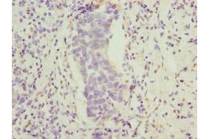 Immunohistochemistry of paraffin-embedded human bladder cancer using ABIN7165470 at dilution of 1:100 (FAM222B anticorps  (AA 351-562))