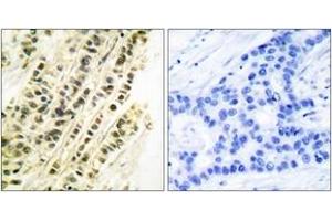 Immunohistochemistry analysis of paraffin-embedded human breast carcinoma tissue, using SRF (Ab-99) Antibody. (SRF anticorps  (AA 71-120))