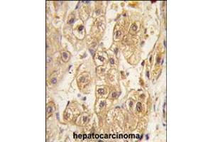 Formalin-fixed and paraffin-embedded human hepatocarcinoma tissue reacted with PDGFRB antibody , which was peroxidase-conjugated to the secondary antibody, followed by DAB staining. (PDGFRB anticorps)