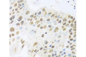 Immunohistochemistry of paraffin-embedded Human lung cancer using ZBTB17 Polyclonal Antibody at dilution of 1:100 (40x lens). (ZBTB17 anticorps)