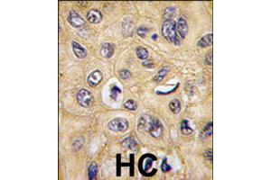 Formalin-fixed and paraffin-embedded human hepatocellular carcinoma reacted with TSC2 polyclonal antibody  , which was peroxidase-conjugated to the secondary antibody, followed by DAB staining . (Tuberin anticorps  (Ser1798))