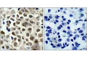 Immunohistochemistry analysis of paraffin-embedded human lung carcinoma, using HDAC8 (Phospho-Ser39) Antibody.