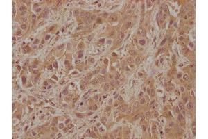 IHC image of ABIN7152833 diluted at 1:100 and staining in paraffin-embedded human liver cancer performed on a Leica BondTM system. (FGFR2 anticorps  (AA 577-821))