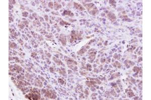 IHC-P Image MAP4K1 antibody [N1], N-term detects MAP4K1 protein at cytosol on BT438 xenograft by immunohistochemical analysis. (MAP4K1 anticorps  (N-Term))