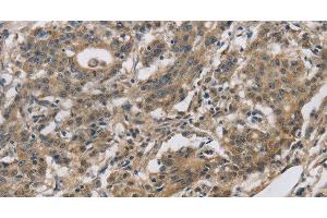 Immunohistochemistry of paraffin-embedded Human gastic cancer using DHRS3 Polyclonal Antibody at dilution of 1:30