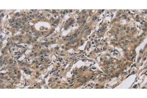 Immunohistochemistry of paraffin-embedded Human gastic cancer using DHRS3 Polyclonal Antibody at dilution of 1:30 (DHRS3 anticorps)