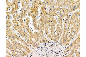 ABIN7095071 and ABIN7099127 at 1/100 staining human liver cancer by IHC-P. (TTPA anticorps)