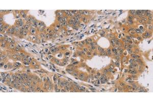 Immunohistochemistry of paraffin-embedded Human gastric cancer using CDK11B Polyclonal Antibody at dilution of 1:40 (CDK11 anticorps)