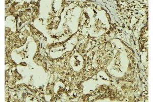 ABIN6273306 at 1/100 staining Human breast cancer tissue by IHC-P. (RBBP9 anticorps  (Internal Region))