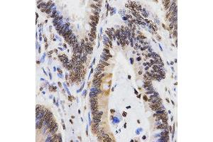 Immunohistochemistry of paraffin-embedded human rectal cancer tissue using H3K9me2 antibody at dilution of 1:200 (x400 lens).