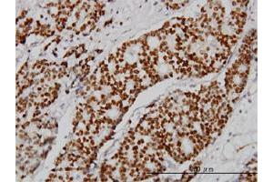 Immunoperoxidase of monoclonal antibody to PGR on formalin-fixed paraffin-embedded human breast cancer.
