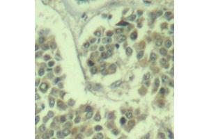 Immunohistochemistry of paraffin-embedded human breast carcinoma using Phospho-eIF2α-S49 antibody (ABIN2987986). (EIF2S1 anticorps  (pSer49))
