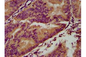 IHC image of ABIN7166221 diluted at 1:200 and staining in paraffin-embedded human endometrial cancer performed on a Leica BondTM system. (IGSF9 anticorps  (AA 132-298))