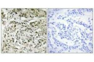 Immunohistochemistry analysis of paraffin-embedded human breast carcinoma tissue, using TAF1 antibody. (TAF1 anticorps)