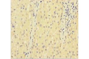 Immunohistochemistry of paraffin-embedded human liver cancer using ABIN7175384 at dilution of 1:100 (VEGFR2/CD309 anticorps  (AA 20-764))