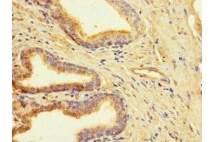 Immunohistochemistry of paraffin-embedded human prostate cancer using ABIN7147948 at dilution of 1:100 (CLUAP1 anticorps  (AA 161-413))