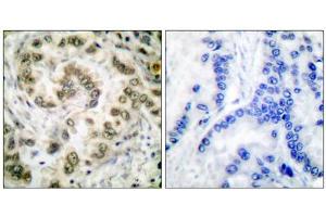 Immunohistochemical analysis of paraffin-embedded human lung carcinoma tissue, using E2F4 antibody (ABIN5976385). (E2F4 anticorps  (Internal Region))