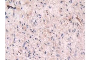 Detection of OAS1 in Human Glioma Tissue using Polyclonal Antibody to 2',5'-Oligoadenylate Synthetase 1 (OAS1) (OAS1 anticorps  (AA 74-165))