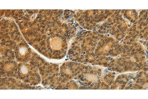 Immunohistochemistry of paraffin-embedded Human thyroid cancer tissue using SOCS5 Polyclonal Antibody at dilution 1:35 (SOCS5 anticorps)