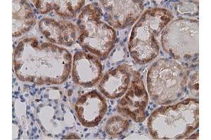 Immunohistochemical staining of paraffin-embedded Carcinoma of Human kidney tissue using anti-SDR9C7 mouse monoclonal antibody.