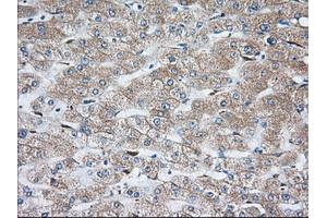 Immunohistochemical staining of paraffin-embedded Carcinoma of Human thyroid tissue using anti-TBXAS1 mouse monoclonal antibody. (TBXAS1 anticorps)