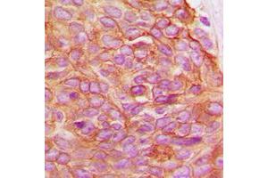 Immunohistochemical analysis of Gamma-catenin staining in human breast cancer formalin fixed paraffin embedded tissue section. (JUP anticorps  (C-Term))