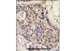 Formalin-fixed and paraffin-embedded human hepatocarcinoma tissue reacted with HGF antibody , which was peroxidase-conjugated to the secondary antibody, followed by DAB staining.