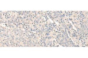 Immunohistochemistry of paraffin-embedded Human cervical cancer tissue using RADIL Polyclonal Antibody at dilution of 1:40(x200)