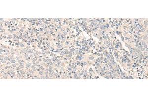 Immunohistochemistry of paraffin-embedded Human cervical cancer tissue using RADIL Polyclonal Antibody at dilution of 1:40(x200) (Radil anticorps)