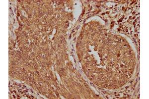 IHC image of ABIN7159477 diluted at 1:100 and staining in paraffin-embedded human cervical cancer performed on a Leica BondTM system. (TRABD2B anticorps  (AA 195-405))