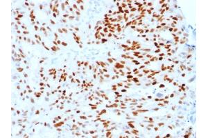 Formalin-fixed, paraffin-embedded human Endometrial Carcinoma stained with Estrogen Receptor alpha Mouse Monoclonal Antibody (ESR1/1904).