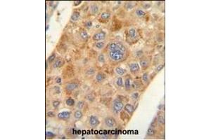 ACR antibody (C-term) (ABIN654069 and ABIN2843966) immunohistochemistry analysis in formalin fixed and paraffin embedded human hepatocarcinoma followed by peroxidase conjugation of the secondary antibody and DAB staining.