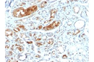 Formalin-fixed, paraffin-embedded human Breast Carcinoma stained with Mammaglobin-Monospecific Mouse Monoclonal Antibody (MGB1/2000).