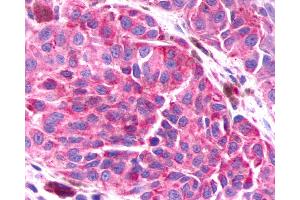 Anti-BAI3 antibody IHC of human Skin, Melanoma.